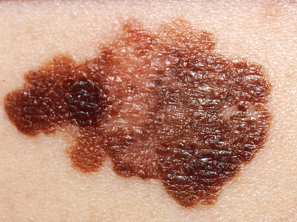 Skin cancers